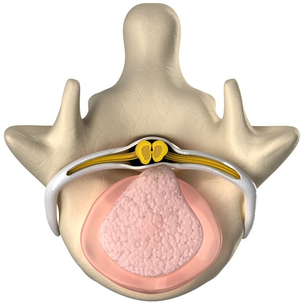 Bulging or Herniated Disc Treatment